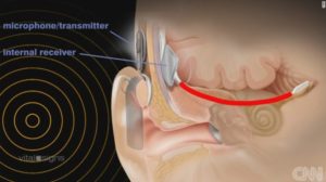 150817101046-auditory-brain-implant-graphic-exlarge-169